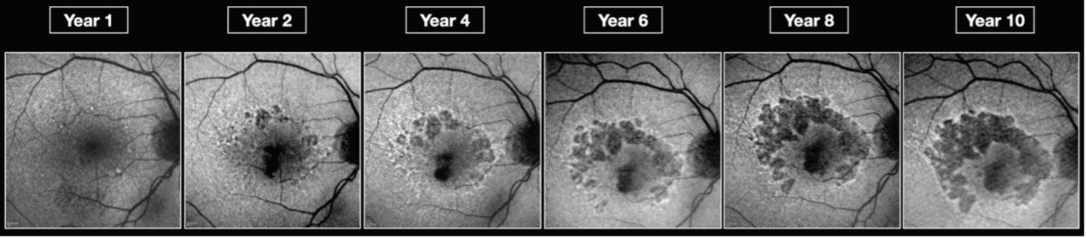 Geographic Atrophy Ga Specialists Surgeons Denver Co Metro Area