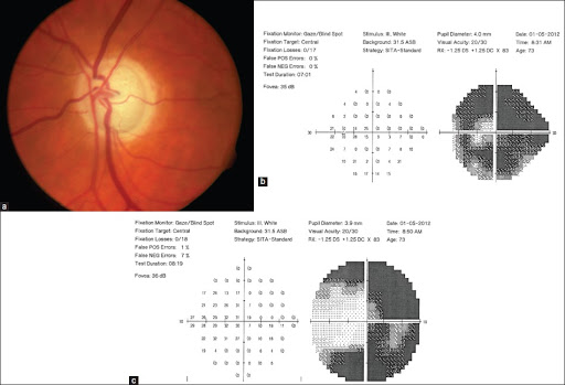 Management Decisions And Surgical Considerations In Severe Glaucoma ...